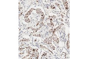 Immunohistochemical analysis of paraffin-embedded Human breast carcinoma tissue using A performed on the Leica® BOND RXm.
