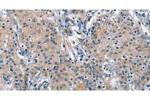 Immunohistochemistry of paraffin-embedded Human gastric cancer using TRIP4 Polyclonal Antibody at dilution of 1:50 (TRIP4 antibody)