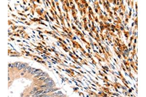 The image on the left is immunohistochemistry of paraffin-embedded Human colon cancer tissue using ABIN7192466(SLC2A5 Antibody) at dilution 1/12, on the right is treated with synthetic peptide.