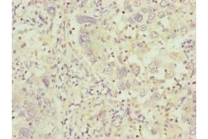 Immunohistochemistry of paraffin-embedded human liver cancer using ABIN7148371 at dilution of 1:100 (C8B antibody  (AA 55-350))