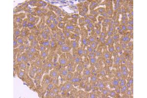 Paraformaldehyde-fixed, paraffin embedded human lung cancer, Antigen retrieval by boiling in sodium citrate buffer (pH6) for 15min, Block endogenous peroxidase by 3% hydrogen peroxide for 30 minutes, Blocking buffer at 37°C for 20min, Antibody incubation with Smad3 (3D1) Monoclonal Antibody  at 1:50 overnight at 4°C, followed by a conjugated secondary and DAB staining. (SMAD3 antibody)