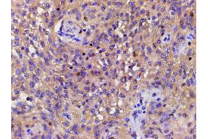 ABIN6267443 at 1/200 staining human meningeal carcinomatosis(MC) tissue sections by IHC-P. (Cofilin antibody  (pSer3))