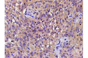 ABIN6267443 at 1/200 staining human meningeal carcinomatosis(MC) tissue sections by IHC-P. (Cofilin antibody  (pSer3))