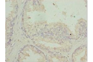 Immunohistochemistry of paraffin-embedded human prostate cancer using ABIN7167729 at dilution of 1:100 (RFPL2 antibody  (AA 99-378))