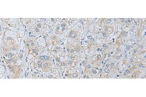 Immunohistochemistry of paraffin-embedded Human liver cancer tissue using NAGK Polyclonal Antibody at dilution of 1:35(x200) (NAGK antibody)