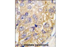 Formalin-fixed and paraffin-embedded human prostata carcinoma tissue reacted with DRAGON (RGMB) , which was peroxidase-conjugated to the secondary antibody, followed by DAB staining. (RGMB antibody  (C-Term))