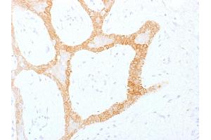 Formalin-fixed, paraffin-embedded human Colon Carcinoma stained with Cytokeratin 5/8 Monoclonal Antibody (C-50). (Keratin 5/8 antibody)