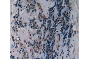 IHC-P analysis of breast cancer tissue, with DAB staining. (SLURP1 antibody  (AA 1-103))