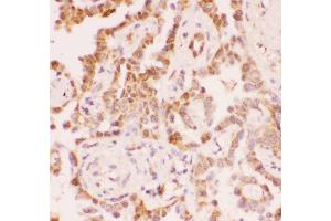 Anti-SIRT2 Picoband antibody,  IHC(P): Human Lung Cancer Tissue (SIRT2 antibody  (Middle Region))