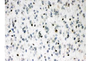 MEF2A was detected in paraffin-embedded sections of human glioma tissues using rabbit anti- MEF2A Antigen Affinity purified polyclonal antibody (Catalog # ) at 1 µg/mL. (MEF2A antibody  (C-Term))