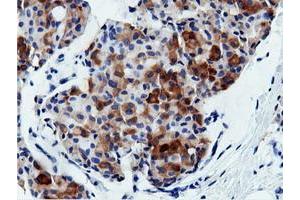 Immunohistochemical staining of paraffin-embedded Adenocarcinoma of Human breast tissue using anti-AK5 mouse monoclonal antibody. (Adenylate Kinase 5 antibody)