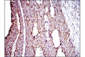 Immunohistochemical analysis of paraffin-embedded rectum cancer tissues using ALDH2 mouse mAb with DAB staining. (ALDH2 antibody  (AA 317-517))