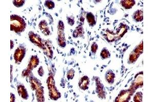 Formalin-fixed, paraffin-embedded human breast carcinoma stained with TFF1 antibody. (TFF1 antibody  (C-Term))