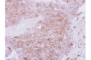 IHC-P Image Immunohistochemical analysis of paraffin-embedded human ovarian carcinoma, using RhoC, antibody at 1:250 dilution.