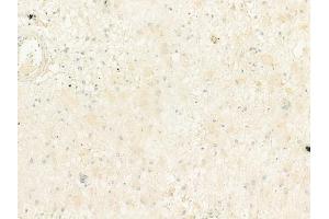 ABIN6264450 and ABIN6273067 at 1/100 staining human astrocytoma by IHC-P.