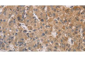 Immunohistochemistry of paraffin-embedded Human liver cancer tissue using DSTN Polyclonal Antibody at dilution 1:30 (Destrin antibody)