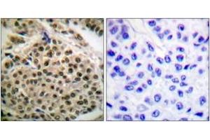 Immunohistochemistry analysis of paraffin-embedded human breast carcinoma, using NF-kappaB p105/p50 (Phospho-Ser927) Antibody. (NFKB1 antibody  (pSer927))