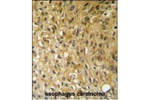 SSN1 Antibody (Center) (ABIN652058 and ABIN2840526) immunohistochemistry analysis in formalin fixed and paraffin embedded human esophagus carcinoma followed by peroxidase conjugation of the secondary antibody and DAB staining. (SAMSN1 antibody  (AA 255-283))