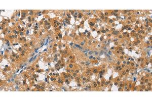 Immunohistochemistry of paraffin-embedded Human thyroid cancer tissue using CUL7 Polyclonal Antibody at dilution 1:50 (Cullin 7 antibody)