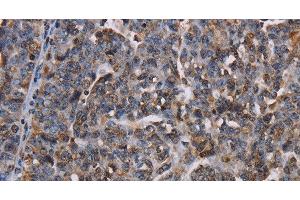 Immunohistochemistry of paraffin-embedded Human ovarian cancer using LBR Polyclonal Antibody at dilution of 1:50 (Lamin B Receptor antibody)