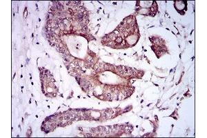 Immunohistochemical analysis of paraffin-embedded colon cancer tissues using BMPR1A mouse mAb with DAB staining. (BMPR1A antibody  (AA 179-378))