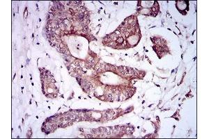 Immunohistochemical analysis of paraffin-embedded colon cancer tissues using BMPR1A mouse mAb with DAB staining. (BMPR1A antibody  (AA 179-378))