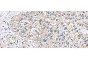 Immunohistochemistry of paraffin-embedded Human esophagus cancer tissue using ABCA10 Polyclonal Antibody at dilution of 1:50(x200) (ABCA10 antibody)