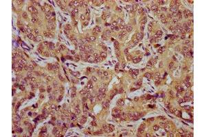 IHC image of ABIN7171794 diluted at 1:800 and staining in paraffin-embedded human liver cancer performed on a Leica BondTM system. (TES antibody  (AA 130-260))