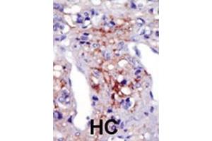 Formalin-fixed and paraffin-embedded human cancer tissue reacted with the primary antibody, which was peroxidase-conjugated to the secondary antibody, followed by AEC staining. (PIP5K1C antibody  (N-Term))