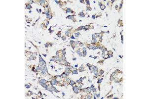 Immunohistochemistry of paraffin-embedded human gastric cancer using TSC1 antibody (ABIN6133755, ABIN6149609, ABIN6149610 and ABIN6213968) at dilution of 1:200 (40x lens). (TSC1 antibody  (AA 550-650))