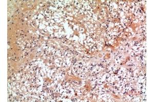 Immunohistochemical analysis of paraffin-embedded human-oophoroma, antibody was diluted at 1:100.