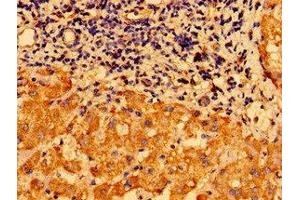 Immunohistochemistry of paraffin-embedded human liver cancer using ABIN7147612 at dilution of 1:100 (CHDH antibody  (AA 30-223))