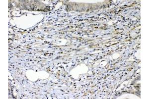 IHC testing of FFPE human intestinal cancer tissue with VEGFR2 antibody at 1ug/ml. (VEGFR2/CD309 antibody)