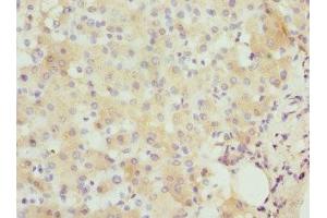 Immunohistochemistry of paraffin-embedded human liver cancer using ABIN7156584 at dilution of 1:100 (IFNB1 antibody  (AA 22-187))