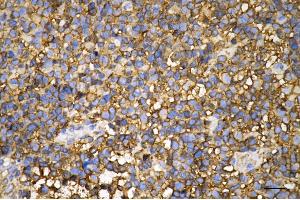 Immunohistochemistry was performed on paraffin-embedded human glioblastoma using pannexin 1 antibody (ABIN7799733), 1:200).