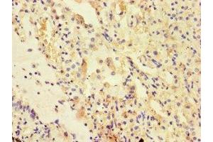 Immunohistochemistry of paraffin-embedded human lung cancer using ABIN7175178 at dilution of 1:100 (UVRAG antibody  (AA 375-425))