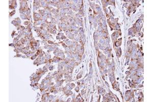 IHC-P Image Immunohistochemical analysis of paraffin-embedded OVCAR3 xenograft , using SGSH, antibody at 1:100 dilution. (SGSH antibody  (C-Term))