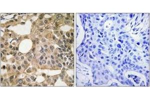 Immunohistochemistry analysis of paraffin-embedded human breast carcinoma tissue, using BCL-XL (Ab-115) Antibody.