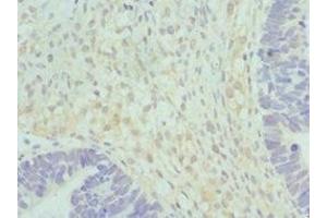 Immunohistochemistry of paraffin-embedded human ovarian cancer using ABIN7152037 at dilution of 1:100 (HSD17B2 antibody  (AA 118-387))