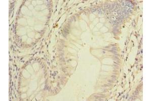 Immunohistochemistry of paraffin-embedded human colon cancer using ABIN7168953 at dilution of 1:100 (C7orf45 antibody  (AA 56-244))