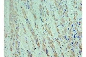 Immunohistochemistry of paraffin-embedded human colon cancer using ABIN7148906 at dilution of 1:100 (CDK9 antibody  (AA 153-372))