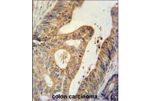 BTG1 Antibody immunohistochemistry analysis in formalin fixed and paraffin embedded human colon carcinoma followed by peroxidase conjugation of the secondary antibody and DAB staining.