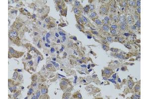 Immunohistochemistry of paraffin-embedded human breast cancer using GNA15 antibody (ABIN5971107) at dilution of 1/100 (40x lens). (GNA15 antibody)
