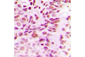 Immunohistochemical analysis of DNMT3B staining in human breast cancer formalin fixed paraffin embedded tissue section. (DNMT3B antibody  (N-Term))