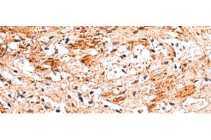 Immunohistochemistry of paraffin-embedded Human liver cancer tissue using NADK Polyclonal Antibody at dilution of 1:70(x200) (NADK antibody)
