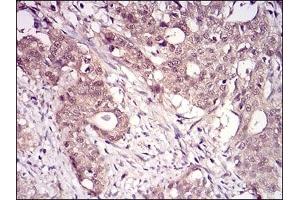 Immunohistochemical analysis of paraffin-embedded human cervical cancer tissues using RANBP9 mouse mAb with DAB staining. (Importin 9 antibody  (AA 453-680))