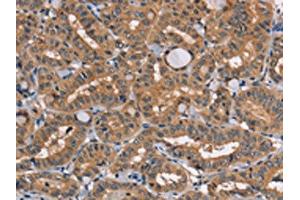 The image on the left is immunohistochemistry of paraffin-embedded Human thyroid cancer tissue using ABIN7131459(TRAFD1 Antibody) at dilution 1/20, on the right is treated with fusion protein. (TRAFD1 antibody)