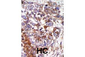Formalin-fixed and paraffin-embedded human hepatocellular carcinoma tissue reacted with PRKG1 polyclonal antibody  , which was peroxidase-conjugated to the secondary antibody, followed by AEC staining. (PRKG1 antibody  (C-Term))