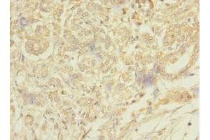 Immunohistochemistry of paraffin-embedded human pancreatic cancer using ABIN7159422 at dilution of 1:100