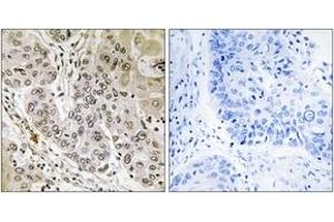 Immunohistochemistry analysis of paraffin-embedded human lung carcinoma tissue, using STK36 Antibody. (STK36 antibody  (AA 387-436))